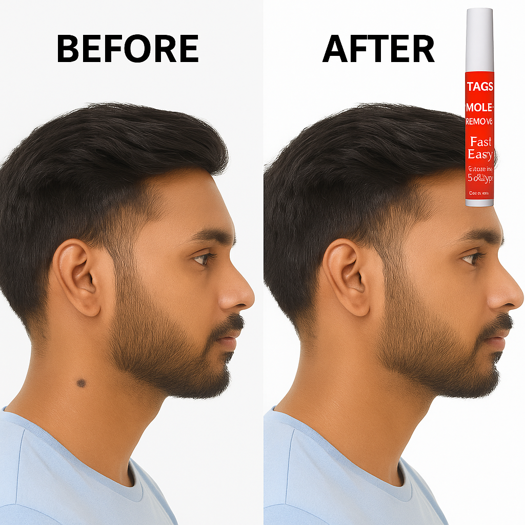 ✨ Tag & Mole Remover Pen 🔥 – Clear Skin in 5 Days! 🌿 Buy 1 Get 1 FREE 💥